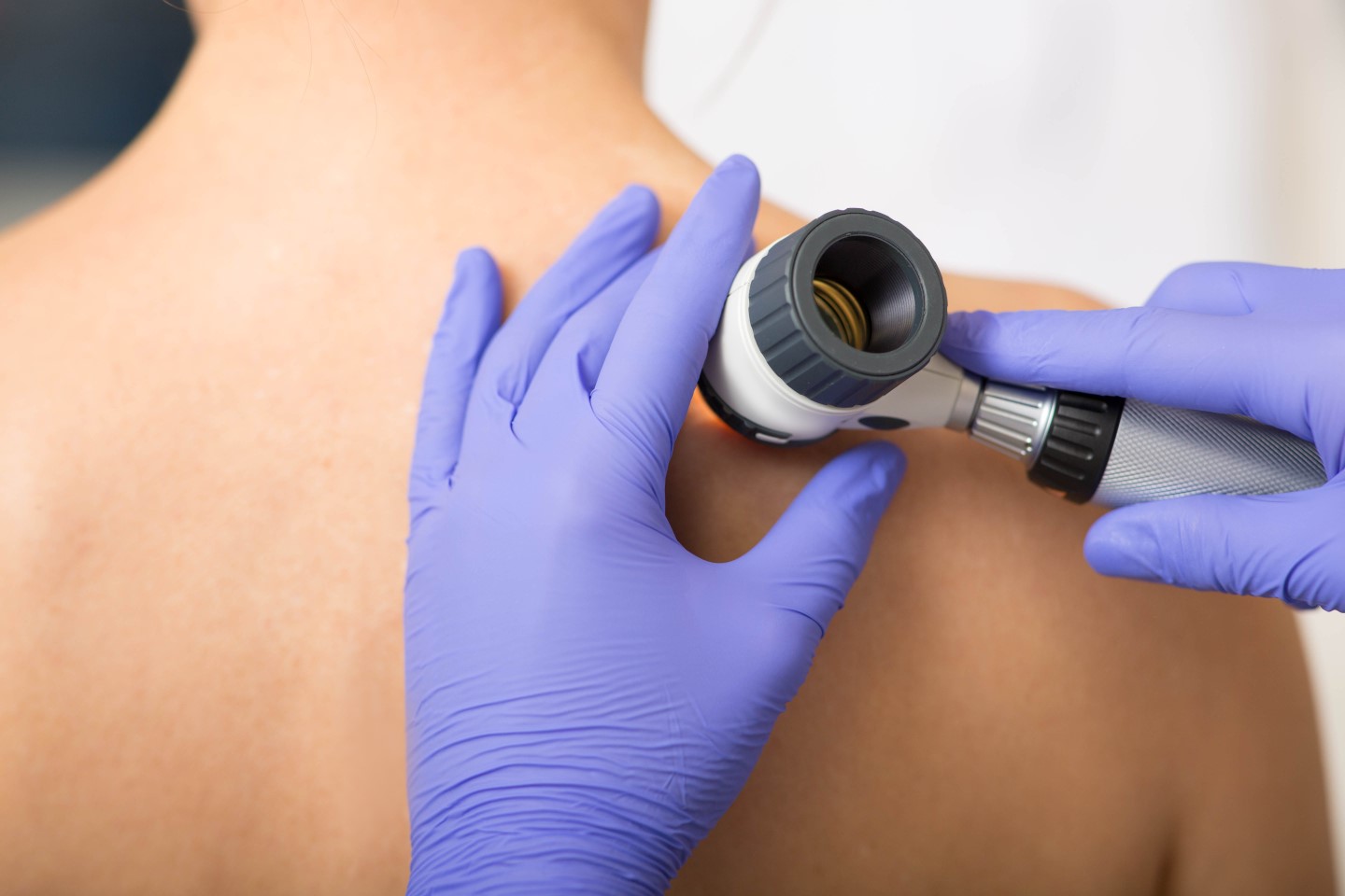 skin-cancer-screenings